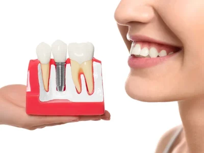 Miami-Dental-Implants-The-Permanent-Solution-to-Missing-Teeth